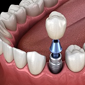 Dental implant in Rancho Park