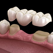 a computer illustration of a traditional dental bridge