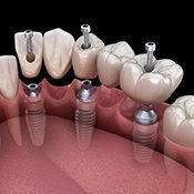 a computer illustration of an implant bridge