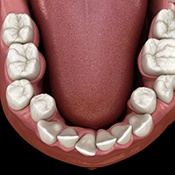 Illustration of crooked teeth