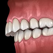 Illustration of an overbite