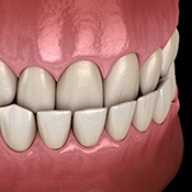Illustration of an underbite