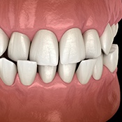 Illustration of a crossbite