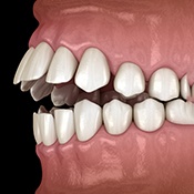 Illustration of an open bite