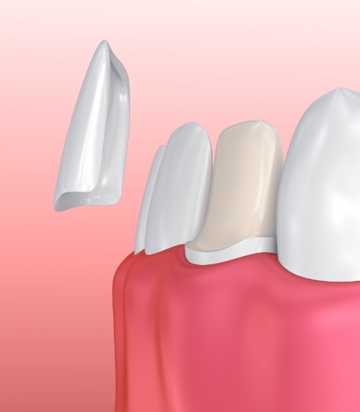 Animated smile during porcelain veneer cosmetic dentistry treatment