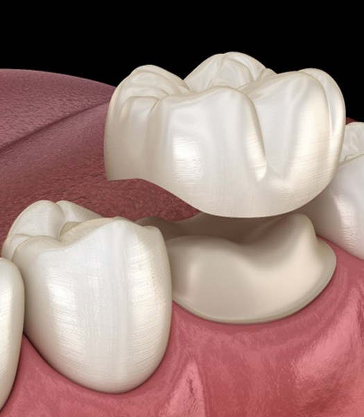 Dental crown in Los Angeles