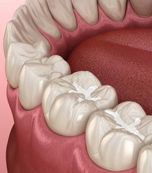 Illustration of teeth with tooth-colored fillings in Los Angeles, CA