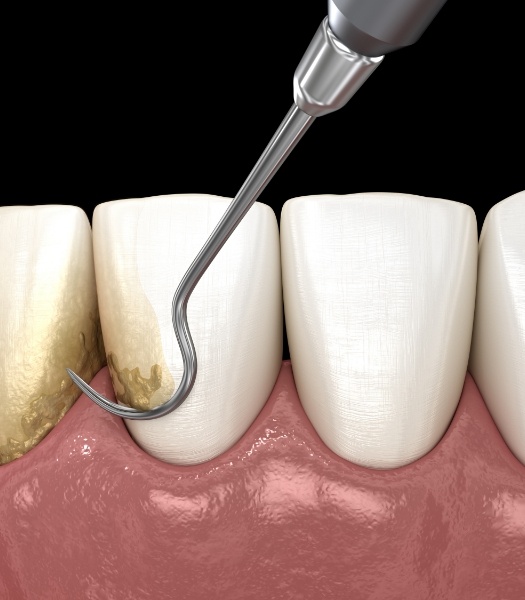 Animated smile during scaling and root planing periodontal therapy for gum disease