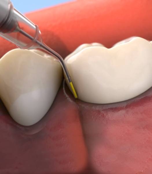 Animated smile during topical antibiotic therapy