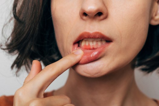 Woman with gum irritation