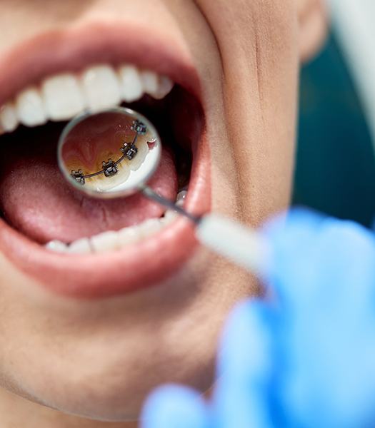 Using dental mirror to show Powerprox braces on backs of teeth
