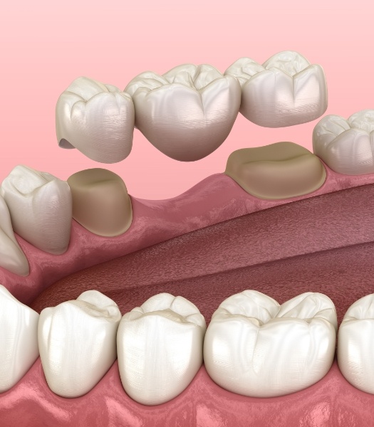 Animated smile during dental bridge restoration to replace missing teeth