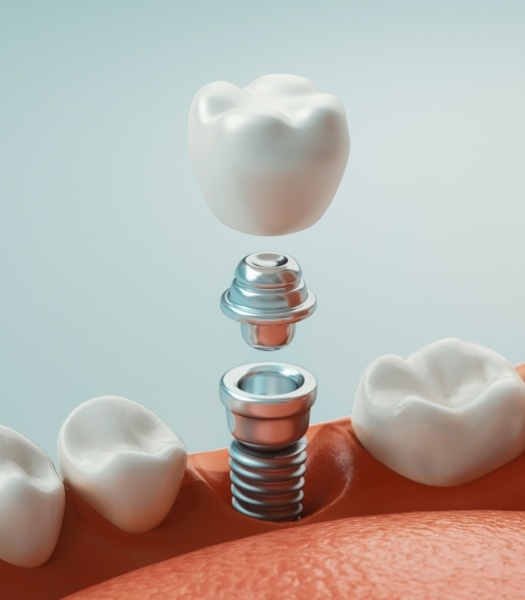 Animated dental implant supported dental crown placement