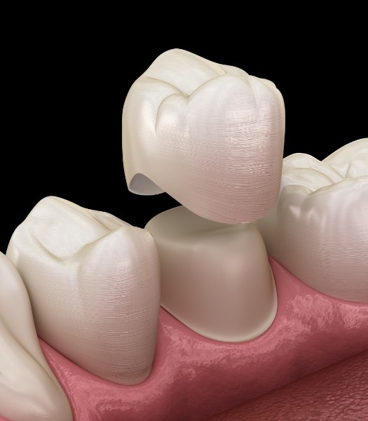 Animated smile during dental crown placement