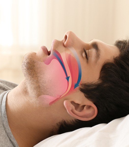 Patient snoring before sleep apnea therapy with animated airway obstruction over his cheek