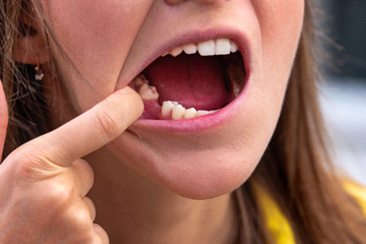 Woman missing a tooth