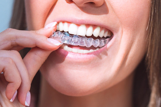 Woman with clear aligners