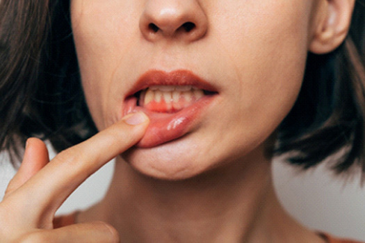 Woman with gum irritation