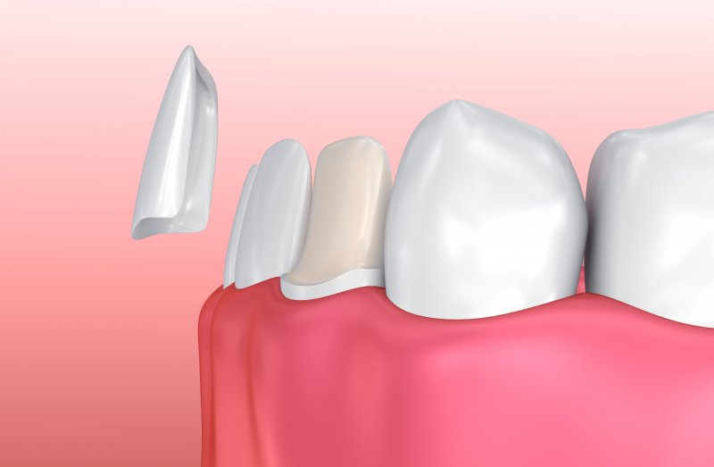 3D rendering of porcelain veneer placement