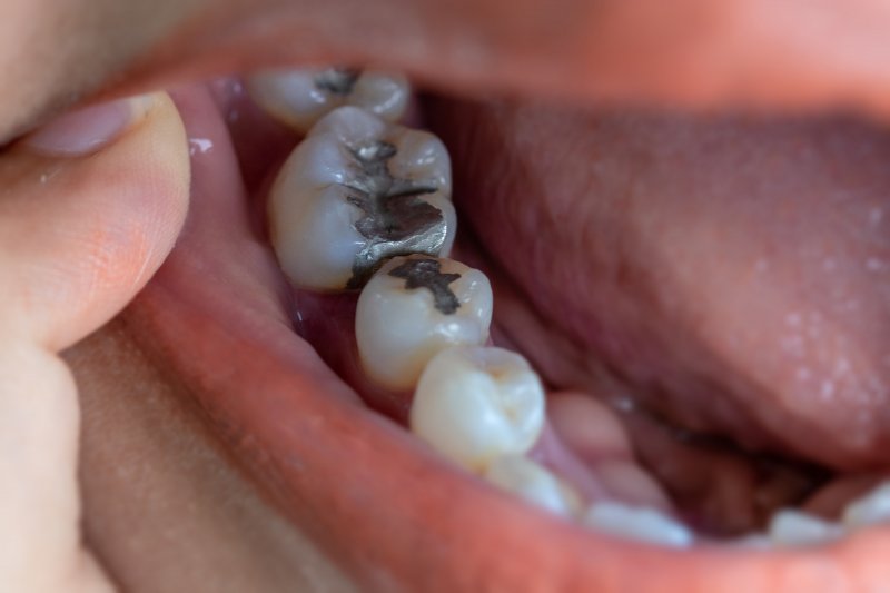 A patient with several amalgam fillings
