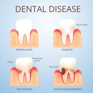 Illustration showing formation of periodontal pockets