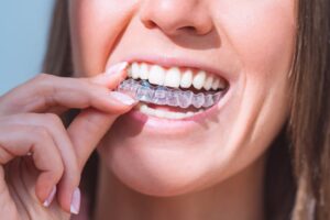 Woman fitting on clear aligners. 